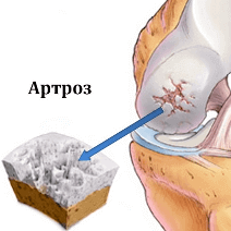 Arthron Meridian - чем лечить грибок стопы
